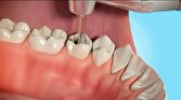عصب کشی عاملی مهم برای دوام دندان‌ها