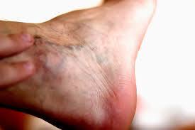 راهکارها و درمان گردش خون ضعیف در پاها